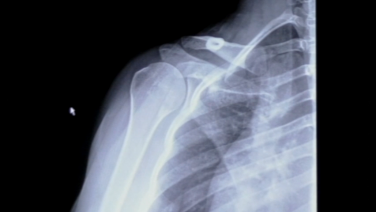 Image from MR Arthrogram & Xray Review for a Labral Tear with Stephanie Muh, MD