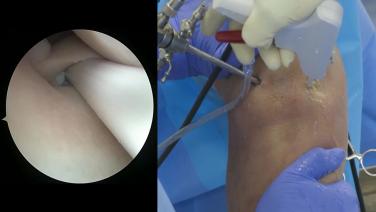 image from Meniscal Capsular Tears (Ramp Lesions) with Kyle Borque, MD