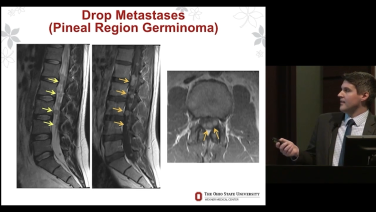 image from Imaging for Spinal Tumors with Daniel Boulter, MD