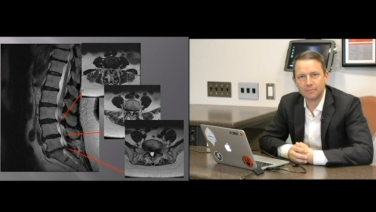 An Image From ""Why the Anterior to Psoas Approach - Joshua Herzog, MDAt the end of this video, you will be able to describe the clinical advantages and disadvantages of the anterior to psoas approach to the lumbar spine."