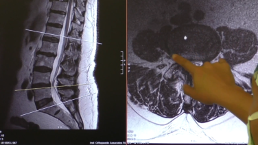 Image from Anterior to Psoas Approach to the Lumbar Spine Surgical Technique Review with Chi Lim, MD