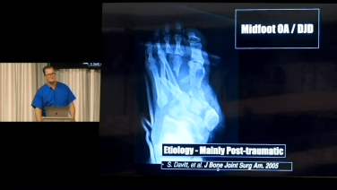 image from Surgical Management of Midfoot Arthritis with Graham Hamilton, DPM