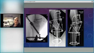Maximizing Post-Traumatic Deformity Correction with Austin Fragomen, MD