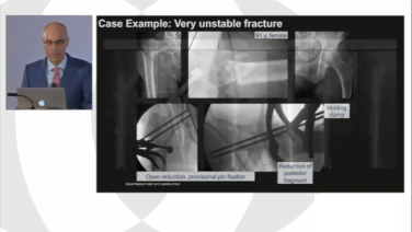slide of different x-ray images from Managing Geriatric Hip Fractures: TFN-Advanced Augmentation System with Michael Blauth, MD, Sunny Konda, MD & Michael O'Boyle, MD