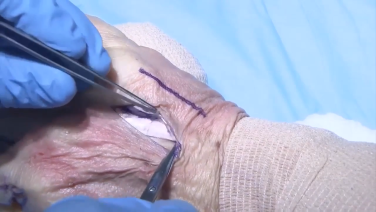 VA Locking Hand System: Metacarpal Neck Plate with Marc Richard, MD