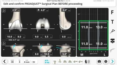 Technology Integration: Robotic Technology Evolution in TKA - Outcomes and Results with Timothy Alton, MD thumbnail