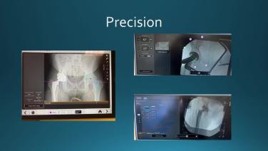 Slide from ANTERIOR ADVANTAGE™ Direct Anterior Total Hip Arthroplasty; Anterior Hip Course with Colin Mudrick, MD