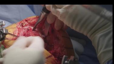 a open knee from Unicompartmental Knee Procedural Workflow with Ryan Nunley, MD