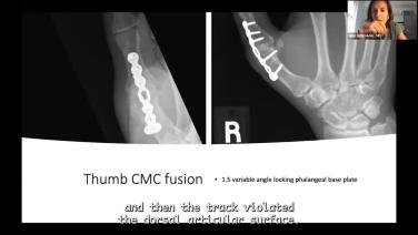 X-ray of a thumb from Controversial Cases in Fractures and Fusion in the Hand & Wrist with R. Glenn Glaston, MD; Nicole Schroeder, MD & Jeffrey Yao, MD