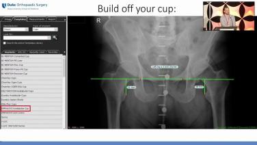 of an xray diagram from Templating & Pre-Operative Planning for Total Hip Arthroplasty with Andrew Schwartz, MD