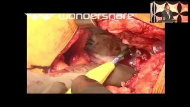 of a point during the procedure for Surgical Approaches to the Hip with William Hamilton, MD