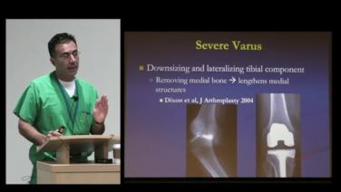 Slide from Moves for TKA Durability with Ali Oliashirazi, MD