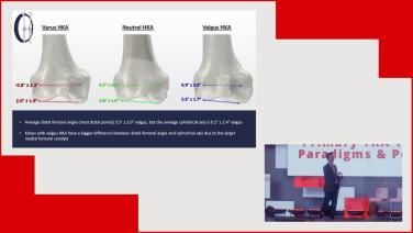 Overview of Knee Kinematics with Chadd Clary, PhD thumbnail