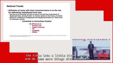 Addressing Fixation in Revision Knees with Cones with Zachary Post, MD thumbnail