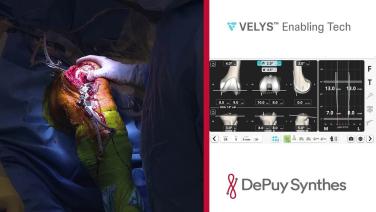 Slide with a knee from Cemented Total Knee Arthroplasty Procedure Featuring VELYS Robotic-Assisted Solution with Robert Mayle, MD