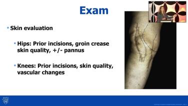 Exam breakdown slide from Total Knee Arthroplasty: Patient History, Physical Exam and Imaging with Katherine Mallet, MD