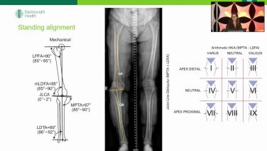 Slide from a power point from Templating & Pre-Operative Planning in Total Knee Arthroplasty with Katherine Mistretta, MD