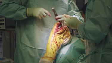 Dr. Reshid Berber holding a knee during a procedure in SIGMA™ Partial Unicondylar Knee Procedure with Dr. Reshid Berber