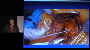Reverse Total Shoulder Arthroplasty for Proximal Humerus Fracture with Paul Favorito, MD