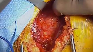 A step of the procedure in Delta XTEND Reverse Shoulder System