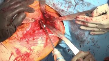 Open Shoulder from Revision Shoulder Arthroplasty Extraction Instrumentation: Case 1