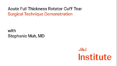 Acute Full Thickness Rotator Cuff Tear - Surgical Demonstration - Stephanie Muh, MD thumbnail