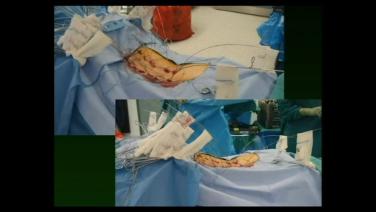 The start of the procedure How VIPER PRIME™ Changed my Practice - Michael Wang, MD