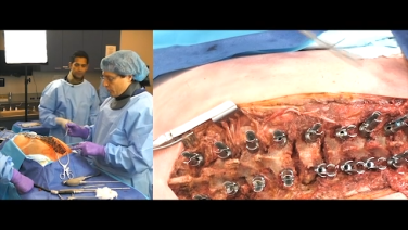 3 Dimensional Deformity Correction with Suken Shah, MD; Baron Lonner, MD; Randal Betz, MD