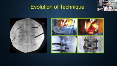 Slide from MIS TLIF Personal Journey & Benefits with Ali Baaj, MD
