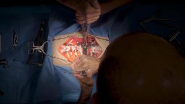 from L4 Pedicle Subtraction Osteotomy Closure: Satellite Rod Technique & Four-Rod Construct for Iatrogenic Flat Back Correction with Nima Alan, MD & Alekos Theologis, MD