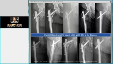 Augmenting Geriatric Fractures with Michael Gardner, MD; Matthew Graves, MD; Michael Leslie, DO; Greg Osgood, MD thumbnail