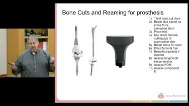 slide from "Proximal Tibia Resection Techniques with Joel Mayerson, MD"