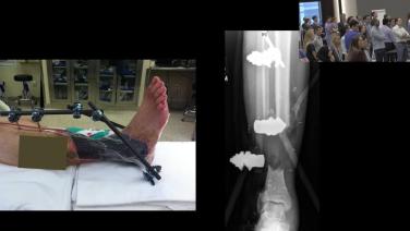 External Fixation - When, Why & How with Jonathan Eastman, MD
