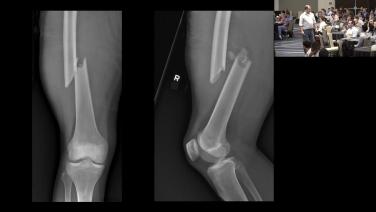 X-ray from Urgent Conditions: Sorting Urgent Femur Injuries with John C. Hagedorn, II, MD