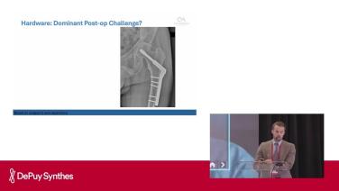 slide from the video Conversion THA with prior hardware; Harder than you think! with Alex Athey, MD