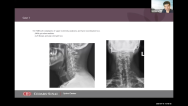 thumbnail image of Role of Biomaterials in Revision Spine Surgery with Hyun Bae, MD & Frank LaMarca, MD