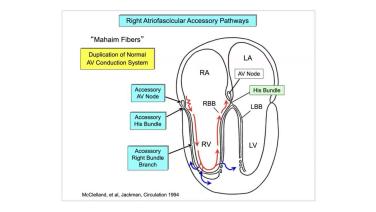 An Image From "Use of ECG and Intracardiac Recordings to Diagnose and Demonstrate the Electrophysiologic Characters of Atriofascicular and Atroventricular Type "Mahaim" Fibers with Warren 'Sonny' Jackman, MD"