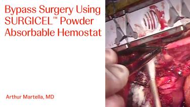 An Image From "Bypass Surgery Using SURGICEL™ Powder Absorbable Hemostat with Arthur Martella, MD"