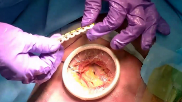 MatrixRIB Lateral