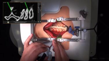 This is an image from the "Navigated Instrumentation in the Posterior Cervical Spine with Prof. Claudius Thome" playlist on the JnJInstitute.com website.