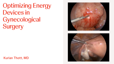 An Image From "Optimizing Energy Devices in Gynecological Surgery with Kurian Thott, MD"
