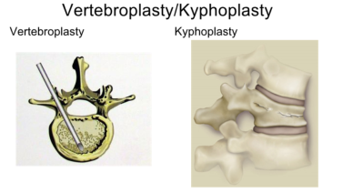 An image from the "Vertebral Body Augmentation in Treatment of Metastatic Spinal Disease: Daniel C. Lu, MD, PHD" on JnJInstitute.com website
