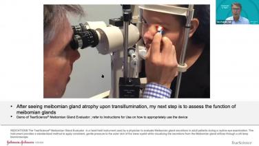 An image from the "Meibomian Gland Assessment with Dr. Timothy Poirier" video on the JnJInstitute.com website.