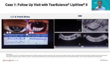 An image from the "MGD in the Contact Lens Patient - A Case of Patient Experiencing Blurry Vision with Dr. Timothy Poirier" video on the JnJInstitute.com website.