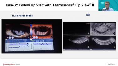 An image from the "MGD in the Contact Lens Patient - A Case of Patient Experiencing Discomfort Wearing Contact Lenses with Dr. Timothy Poirier" video on the JnJInstitute.com website.