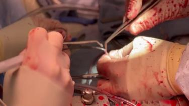 Coronary Artery Bypass Grafting (CABG) - Proximal Anastomosis (single clamp technique) 1/4 - Preparing the Saphenous Vein