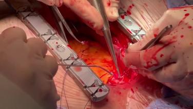 Coronary Artery Bypass Grafting (CABG) - Proximal Anastomosis (single clamp technique) 2/4 - Aortic Punch