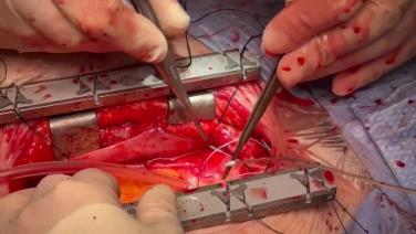 Coronary Artery Bypass Grafting (CABG) - Proximal Anastomosis (single clamp technique) 4/4