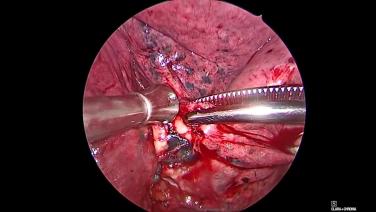Thorascopic Lobectomy - Remove Level 11 & 12 Lymph Nodes