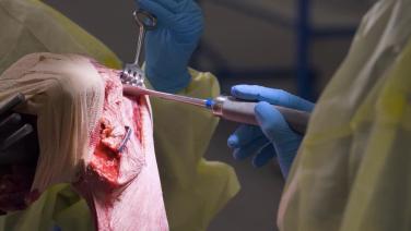 Reverse Total Shoulder Arthroplasty Procedural Workflow with Michael Wiater, MD